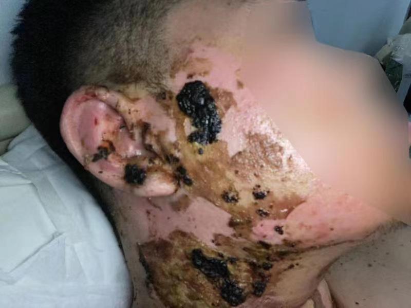 人身伤害要赔 后续康复也要赔 江苏丹阳调解成功拔火罐伤害赔偿消费纠纷